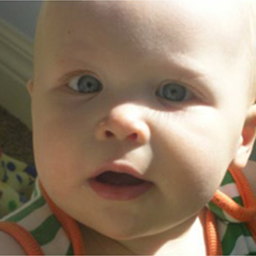 รู้และเข้าใจภาวะตาขี้เกียจในเด็ก 